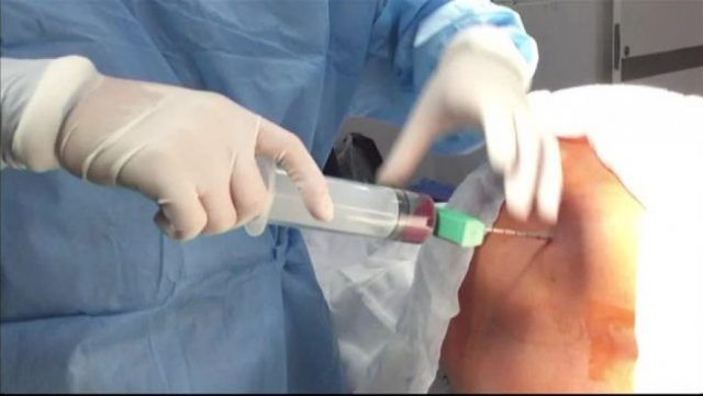 donazione midollo osseo